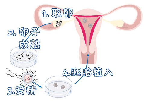 志愿者供卵咨询费用多少生殖中心